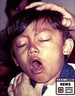 Whooping Cough Crisis in Alaska: Rising Cases and Infant Tragedy